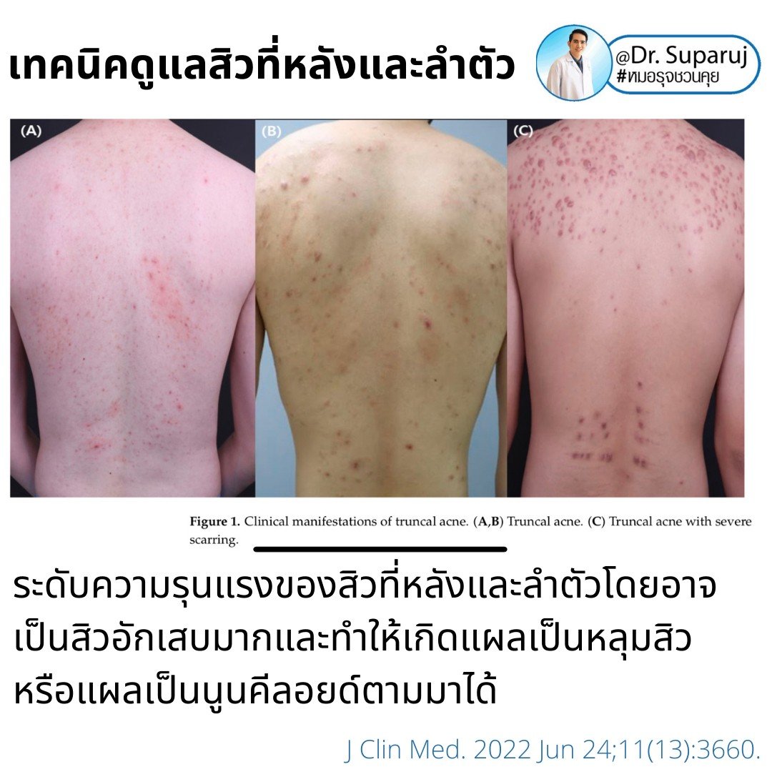 สิวที่หลัง และลำตัว Truncal & Body Acne เกิดจากอะไรและดูแลรักษาได้อย่างไร ? (Update + รีวิว) สิวที่หลัง และลำตัว Truncal & Body Acne เกิดจากอะไรและดูแลรักษาได้อย่างไร ? (Update + รีวิว)