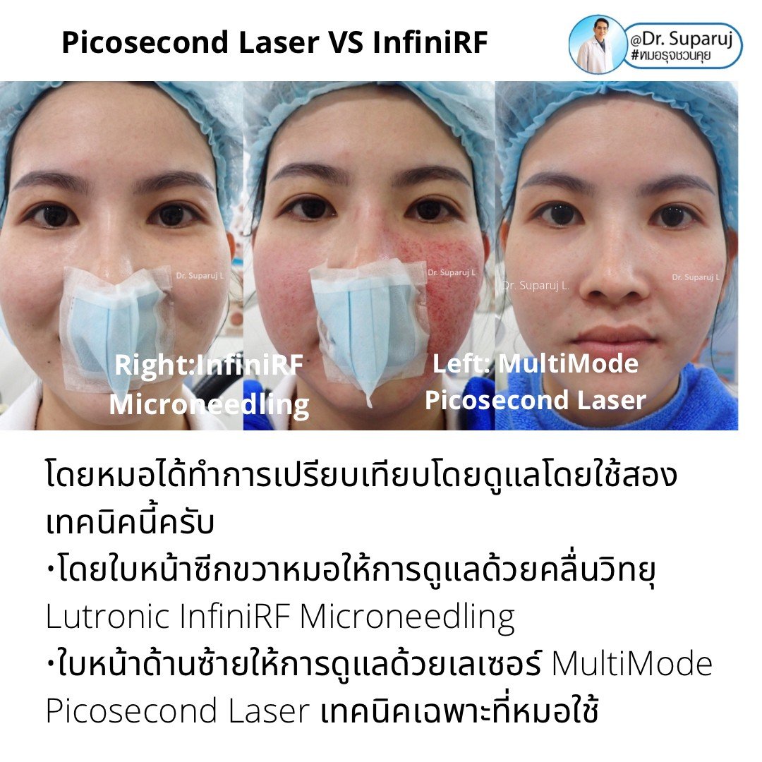 Update ผลการรักษาหลุมสิวด้วย Picosecond Laser VS InfiniRF Microneedle แตกต่างกันอย่างไร อันไหนมีประสิทธิภาพดีกว่า ? Update ผลการรักษาหลุมสิวด้วย Picosecond Laser VS InfiniRF Microneedle แตกต่างกันอย่างไร อันไหนมีประสิทธิภาพดีกว่า ?