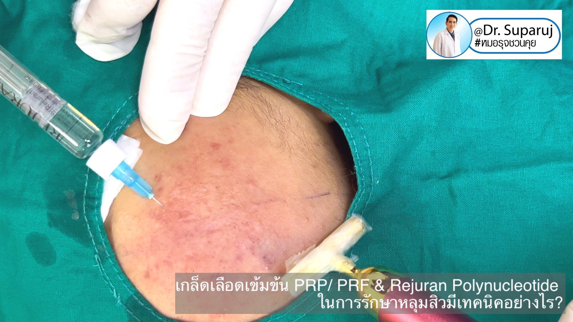 Update เทคนิคดูแลหลุมสิวด้วย Rejuran และ เกล็ดเลือดเข้มข้น PRP/PRF มีเทคนิคอย่างไร? เทคนิคไหนได้ผลดีกว่า ? Update เทคนิคดูแลหลุมสิวด้วย Rejuran และ เกล็ดเลือดเข้มข้น PRP/PRF มีเทคนิคอย่างไร? เทคนิคไหนได้ผลดีกว่า ?