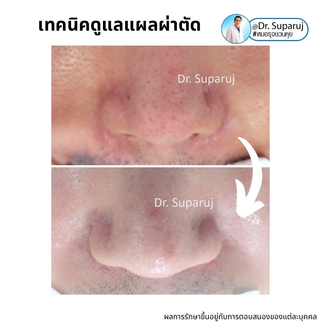 6 ปัจจัยที่ทำให้เกิดแผลเป็นนูนคีลอยด์ 6 ปัจจัยที่ทำให้เกิดแผลเป็นนูนคีลอยด์