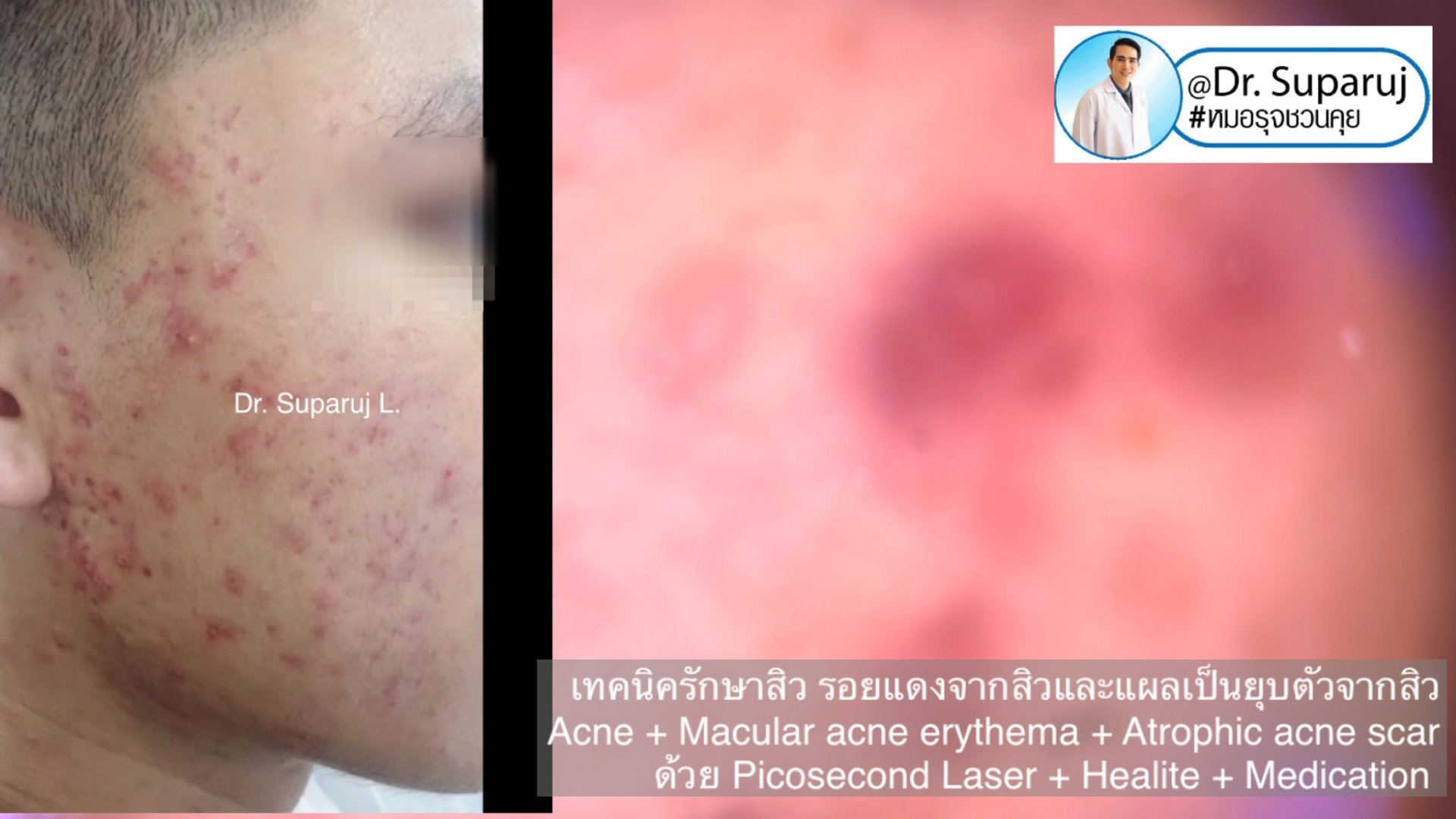แนะนำเทคนิคดูแลรักษาสิวและหลุมสิว: ดูแลรอยแดงจากสิวและแผลเป็นยุบตัวจากสิว Acne + Macular acne erythema + Atrophic acne scar ดูแลด้วย Picosecond Laser + Healite + Medication แนะนำเทคนิคดูแลรักษาสิวและหลุมสิว: ดูแลรอยแดงจากสิวและแผลเป็นยุบตัวจากสิว Acne + Macular acne erythema + Atrophic acne scar ดูแลด้วย Picosecond Laser + Healite + Medication