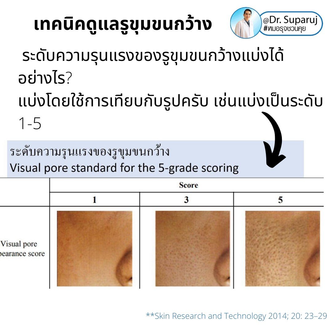 เทคนิควิเคราะห์ & รักษาขุมขนกว้าง Enlarged Facial Pore ด้วยกล้อส่องขยายพิเศษทางผิวหนัง Dermoscopy เทคนิควิเคราะห์ & รักษาขุมขนกว้าง Enlarged Facial Pore ด้วยกล้อส่องขยายพิเศษทางผิวหนัง Dermoscopy