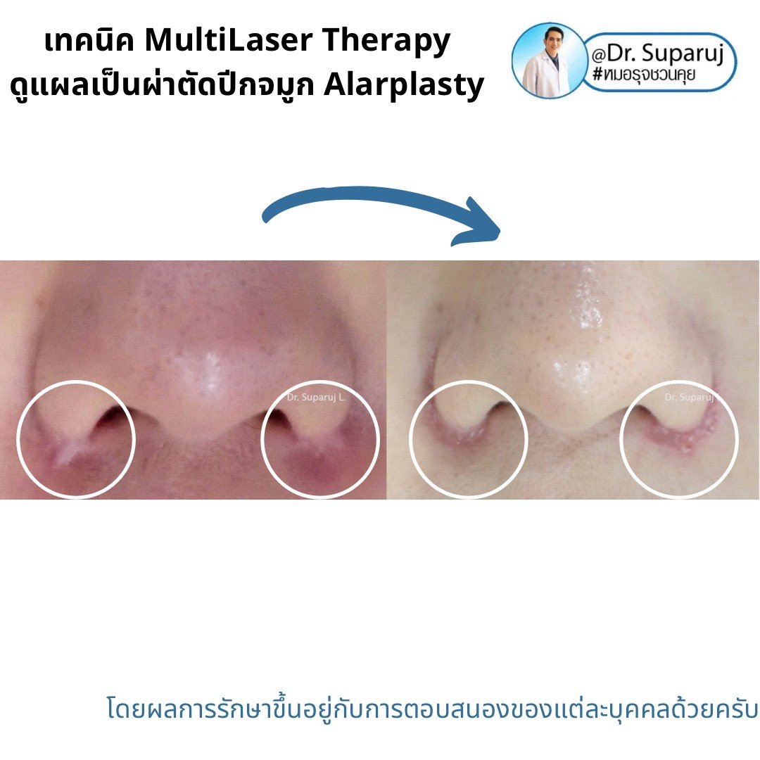 เทคนิคดูแลแผลเป็นด้วยเทคนิค MultiMode MultiLayer Discovery Picosecond Laser with Micro Lens Array MLA