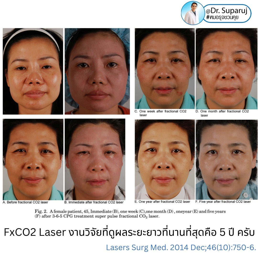 Q: หลังรักษาหลุมสิวด้วยเลเซอร์หรือเทคนิคต่างๆ หลังจากรักษาเรียบร้อยแล้ว จะมีโอกาสกลับมายุบตัว หรือหลุมสิวจะกลับมาแบบเดิมไหม? Q: หลังรักษาหลุมสิวด้วยเลเซอร์หรือเทคนิคต่างๆ หลังจากรักษาเรียบร้อยแล้ว จะมีโอกาสกลับมายุบตัว หรือหลุมสิวจะกลับมาแบบเดิมไหม?