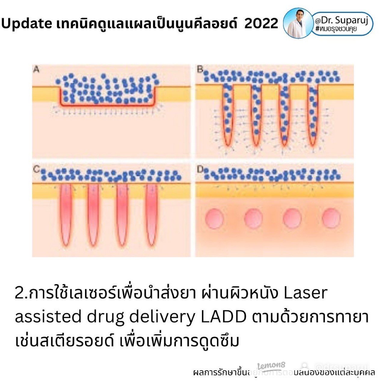 แผลเป็นนูนคีลอยคีลอยด์สามารถรักษาด้วยโดยวิธีผ่าตัดออกได้ไหม ?