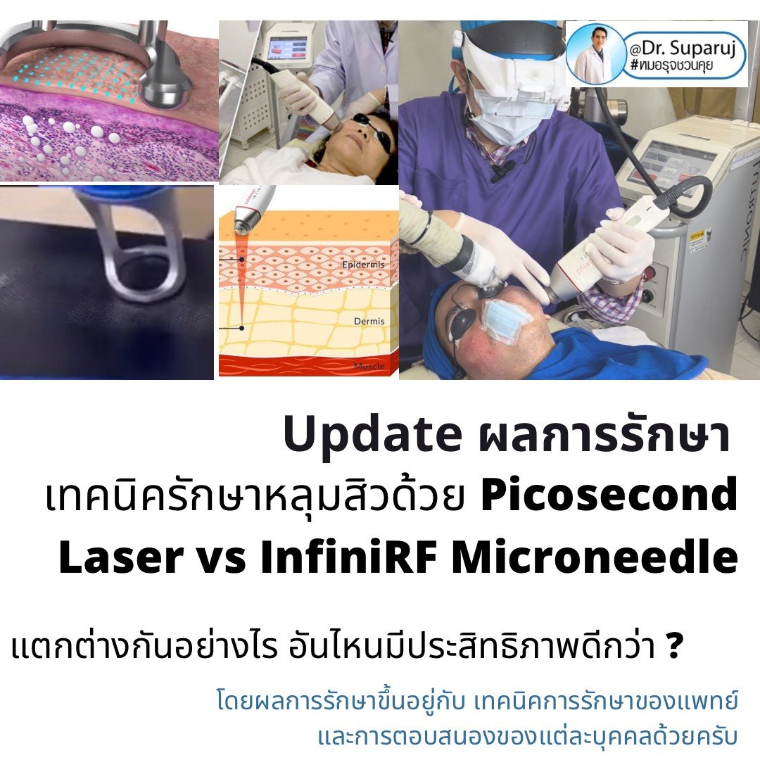 Update ผลการรักษาหลุมสิวด้วย Picosecond Laser VS InfiniRF Microneedle แตกต่างกันอย่างไร อันไหนมีประสิทธิภาพดีกว่า ? Update ผลการรักษาหลุมสิวด้วย Picosecond Laser VS InfiniRF Microneedle แตกต่างกันอย่างไร อันไหนมีประสิทธิภาพดีกว่า ?
