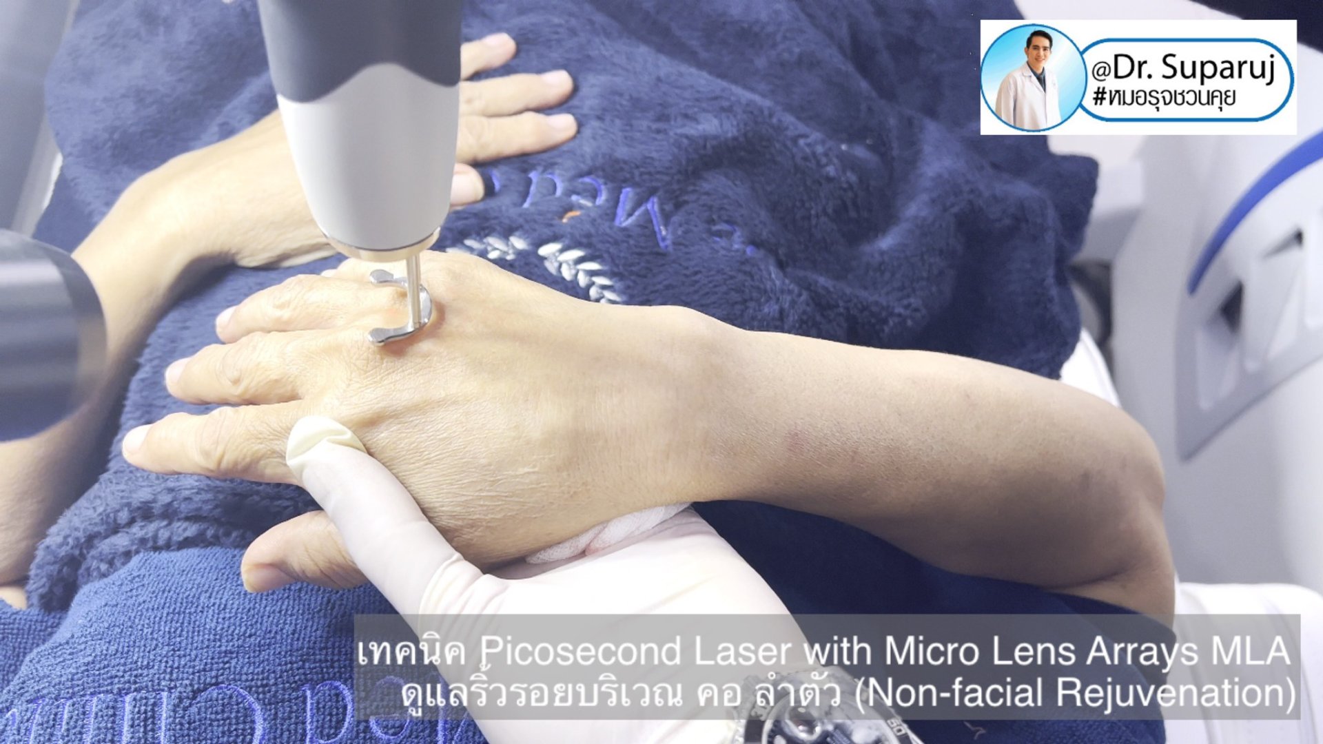 แนะนำ เทคนิคการใช้เลเซอร์ Picosecond Laser with Micro Lens Arrays MLA เพื่อดูแลริ้วรอยบริเวณ คอ ลำตัว (Non-facial rejuvenation)