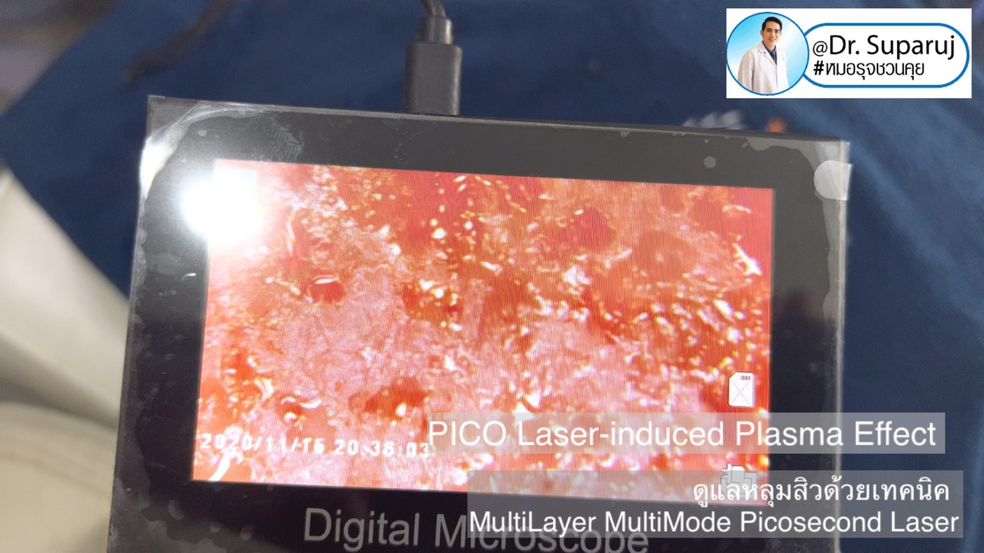 เทคนิครักษาหลุมสิวด้วยเลเซอร์ MultiLayer MultiMode Picosecond Laser เทคนิครักษาหลุมสิวด้วยเลเซอร์ MultiLayer MultiMode Picosecond Laser