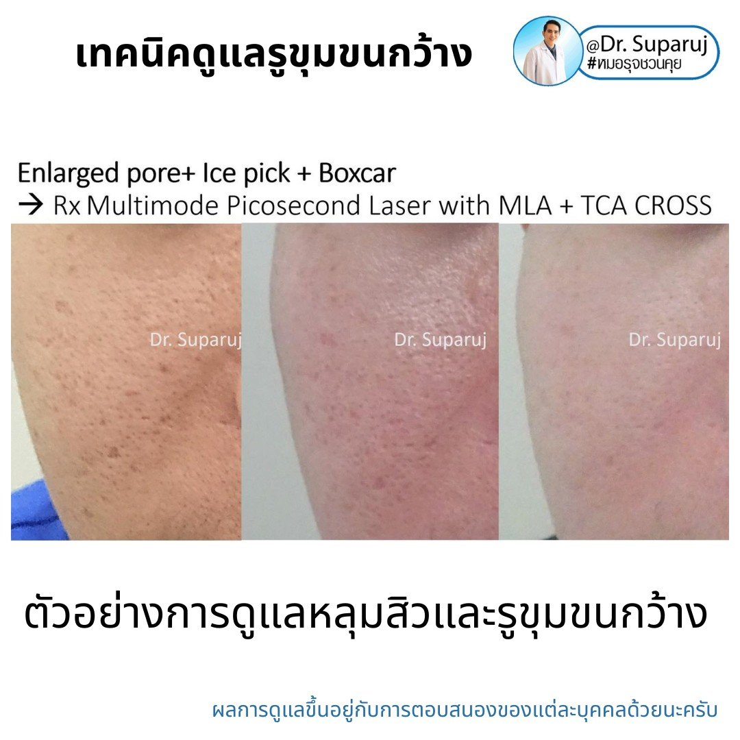 แนะนำเทคนิคดูแลรูขุมขนกว้าง: ตัวอย่างผลการดูแลรูขุมขนกว้าง Enlarged Facial Pore ด้วย MultiMode Picosecond Laser