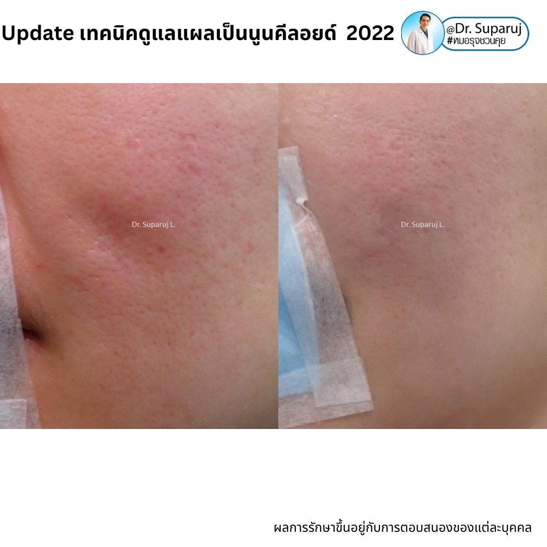 Update เทคนิคดูแลแผลเป็นนูนคีลอยด์ 2022 Update เทคนิคดูแลแผลเป็นนูนคีลอยด์ 2022