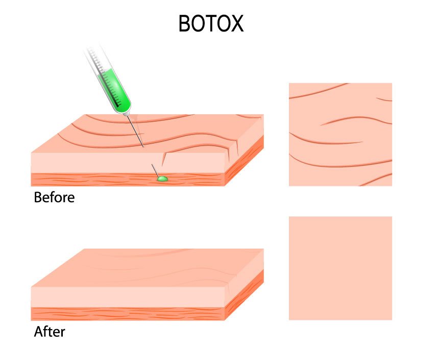 ฉีดโบท็อก Botox (Botulinum Toxin) คืออะไร? ช่วยดูแลปัญหาอะไร เหมาะกับใครบ้าง? ฉีดโบท็อก Botox (Botulinum Toxin) คืออะไร? ช่วยดูแลปัญหาอะไร เหมาะกับใครบ้าง?