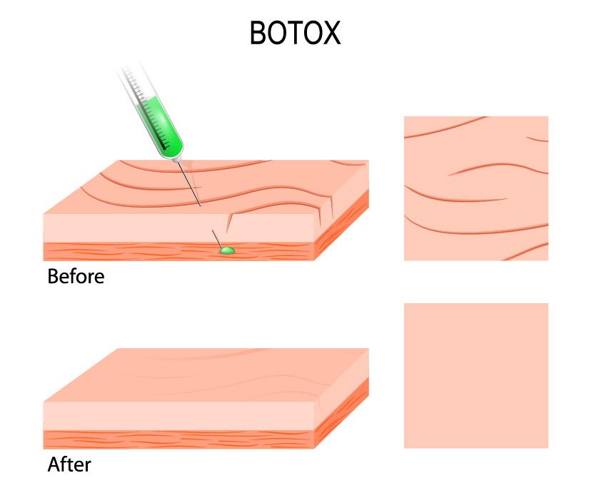 ฉีดโบท็อก Botox (Botulinum Toxin) คืออะไร? ช่วยดูแลปัญหาอะไร เหมาะกับใครบ้าง?
