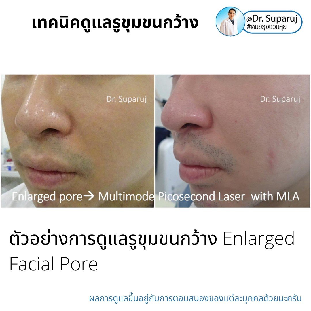 เทคนิควิเคราะห์ & รักษาขุมขนกว้าง Enlarged Facial Pore ด้วยกล้อส่องขยายพิเศษทางผิวหนัง Dermoscopy