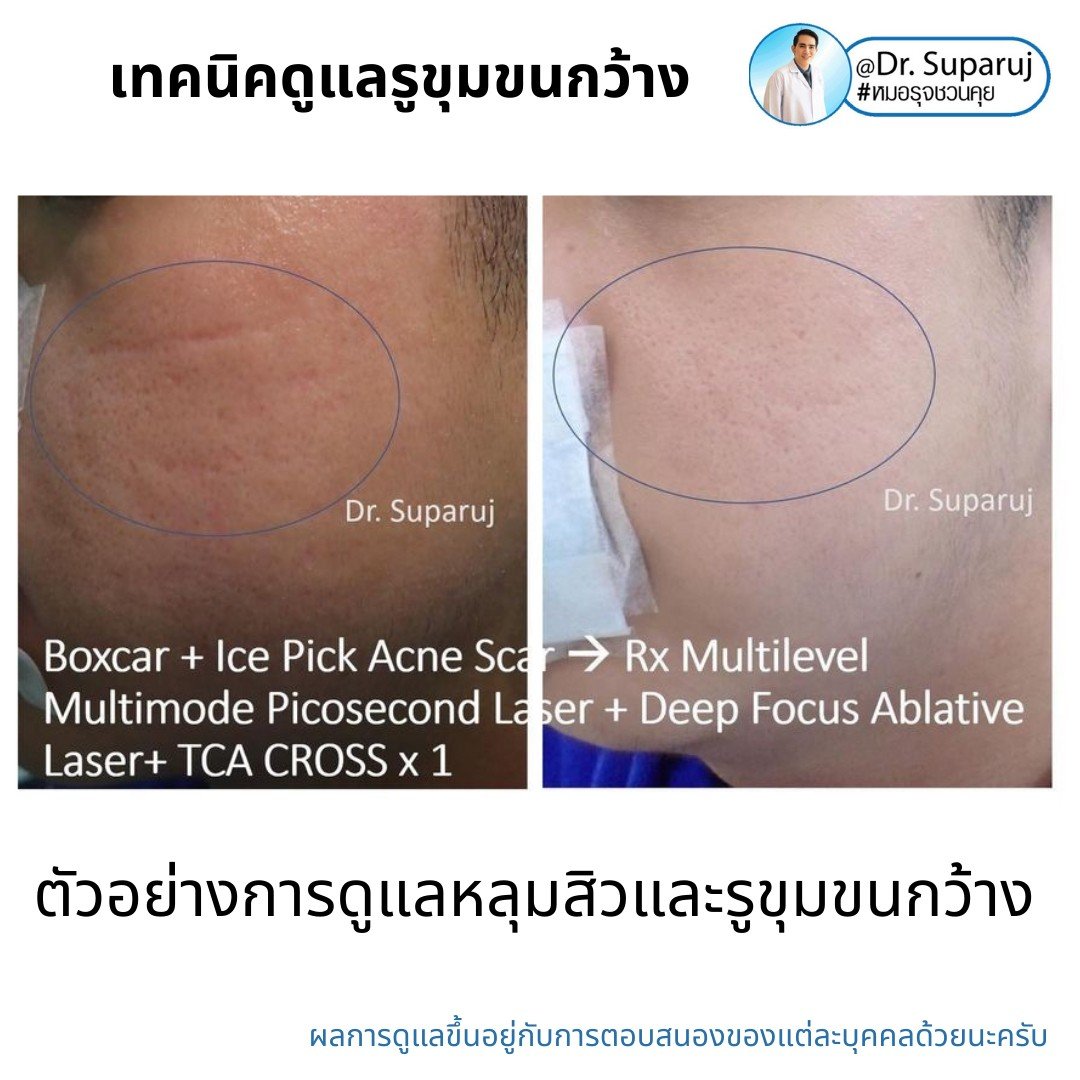 เทคนิควิเคราะห์ & รักษาขุมขนกว้าง Enlarged Facial Pore ด้วยกล้อส่องขยายพิเศษทางผิวหนัง Dermoscopy