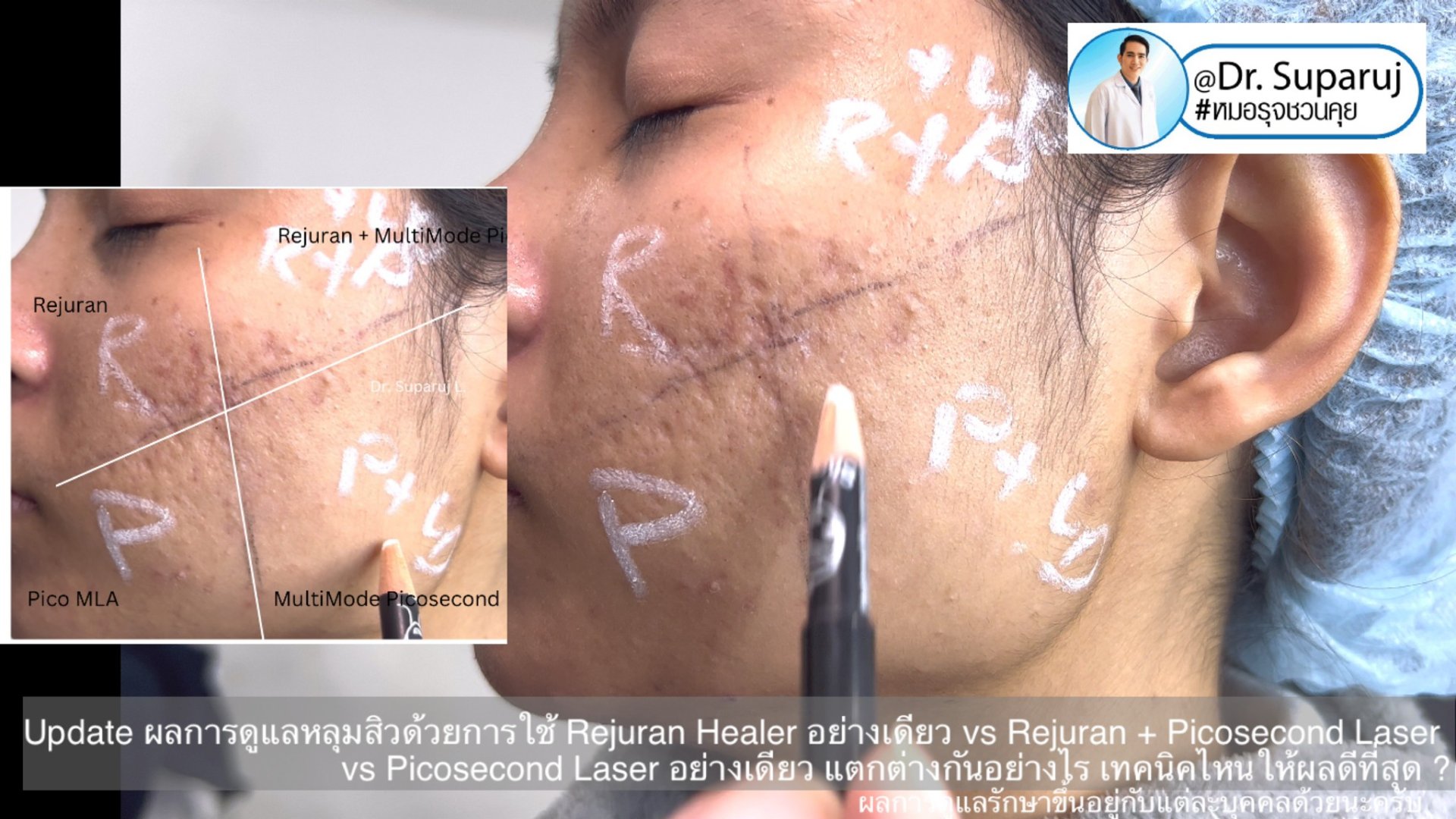 Update ผลการรักษาหลุมสิวด้วยเทคนิค Rejuran Healer อย่างเดียว vs Rejuran + Picosecond Laser vs Picosecond Laser อย่างเดียว แตกต่างกันอย่างไร เทคนิคไหนให้ผลดีที่สุด ? Update ผลการรักษาหลุมสิวด้วยเทคนิค Rejuran Healer อย่างเดียว vs Rejuran + Picosecond Laser vs Picosecond Laser อย่างเดียว แตกต่างกันอย่างไร เทคนิคไหนให้ผลดีที่สุด ?