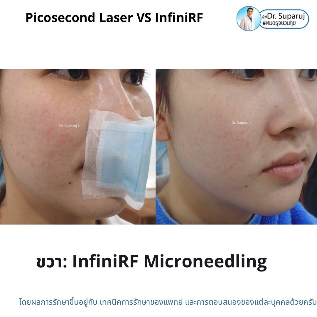 Update ผลการรักษาหลุมสิวด้วย Picosecond Laser VS InfiniRF Microneedle แตกต่างกันอย่างไร อันไหนมีประสิทธิภาพดีกว่า ? Update ผลการรักษาหลุมสิวด้วย Picosecond Laser VS InfiniRF Microneedle แตกต่างกันอย่างไร อันไหนมีประสิทธิภาพดีกว่า ?