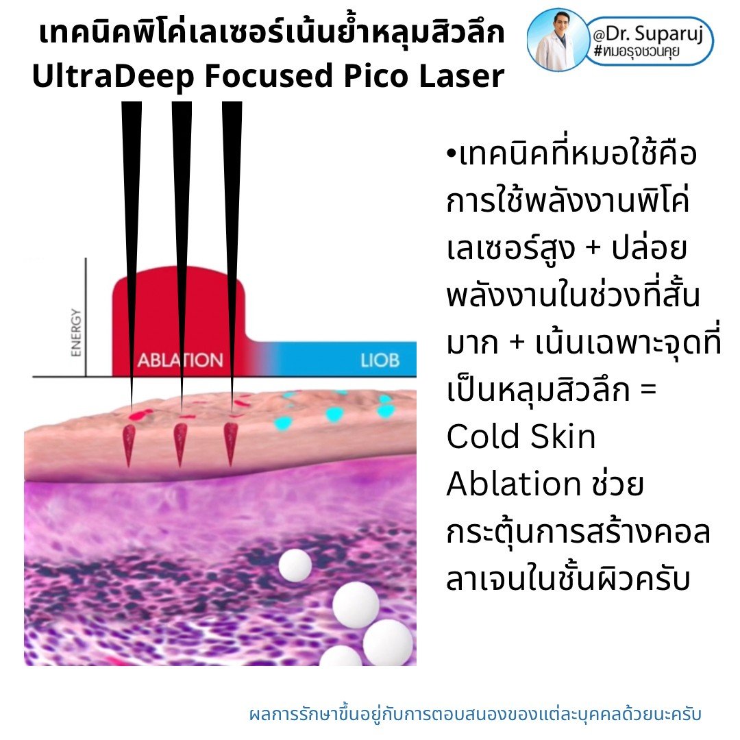 แนะนำเทคนิคดูแลหลุมสิว: เทคนิคพิโค่เลเซอร์เน้นย้ำหลุมสิวลึก UltraDeep Focused Picosecond Laser