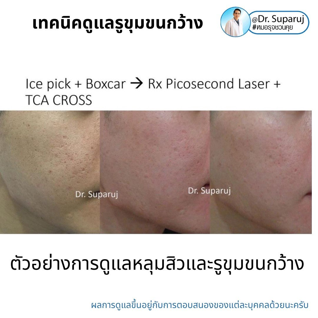 แนะนำเทคนิคดูแลรูขุมขนกว้าง: ตัวอย่างผลการดูแลรูขุมขนกว้าง Enlarged Facial Pore ด้วย MultiMode Picosecond Laser แนะนำเทคนิคดูแลรูขุมขนกว้าง: ตัวอย่างผลการดูแลรูขุมขนกว้าง Enlarged Facial Pore ด้วย MultiMode Picosecond Laser