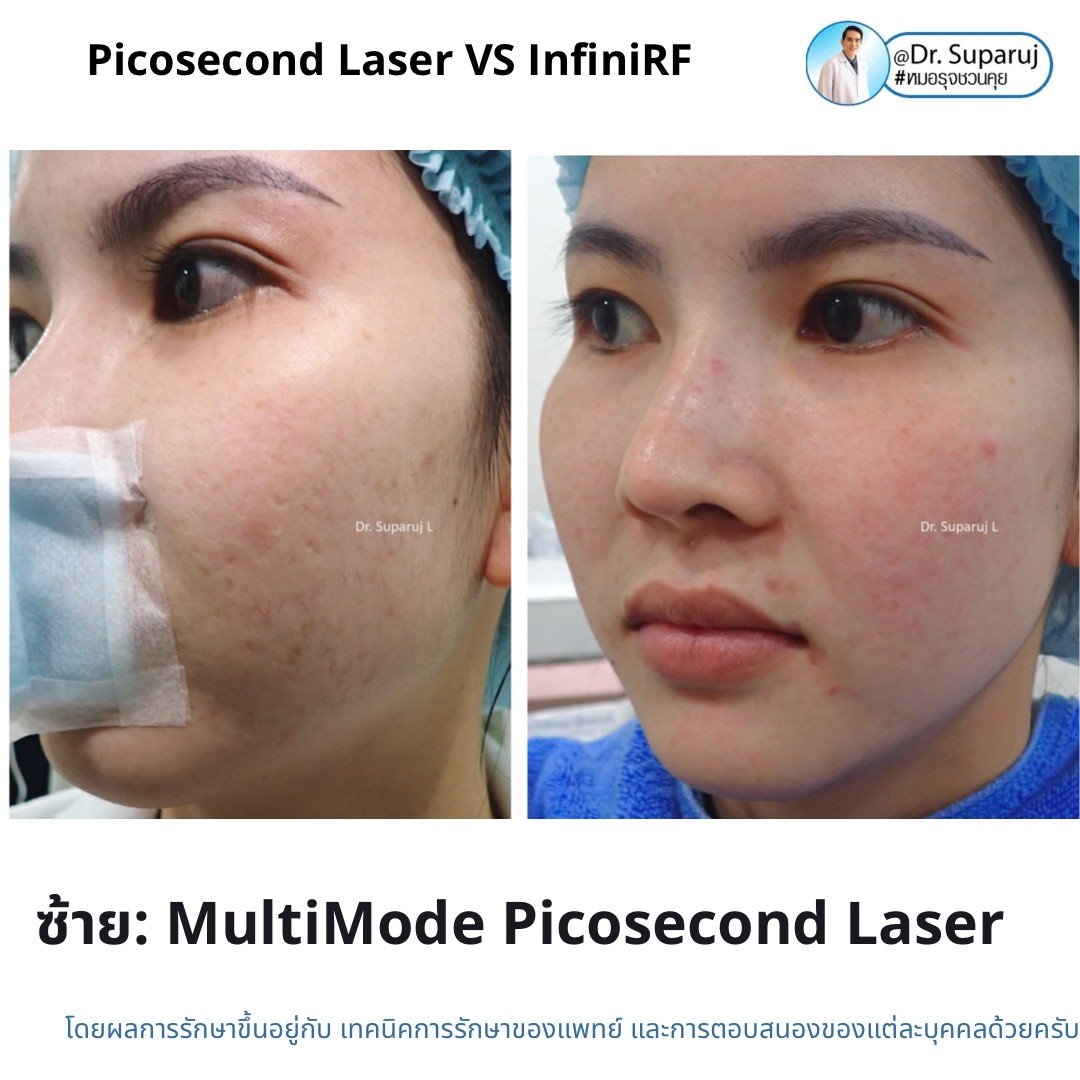 Update ผลการรักษาหลุมสิวด้วย Picosecond Laser VS InfiniRF Microneedle แตกต่างกันอย่างไร อันไหนมีประสิทธิภาพดีกว่า ? Update ผลการรักษาหลุมสิวด้วย Picosecond Laser VS InfiniRF Microneedle แตกต่างกันอย่างไร อันไหนมีประสิทธิภาพดีกว่า ?