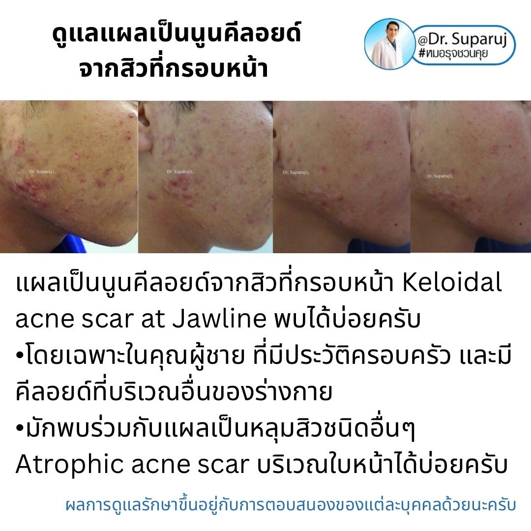  แนะนำเทคนิคดูแลแผลเป็นนูนคีลอยด์จากสิวที่กรอบหน้า MultiLaser Therapy and Injection Technique to Treat Keloid Acne Scar on Jawline