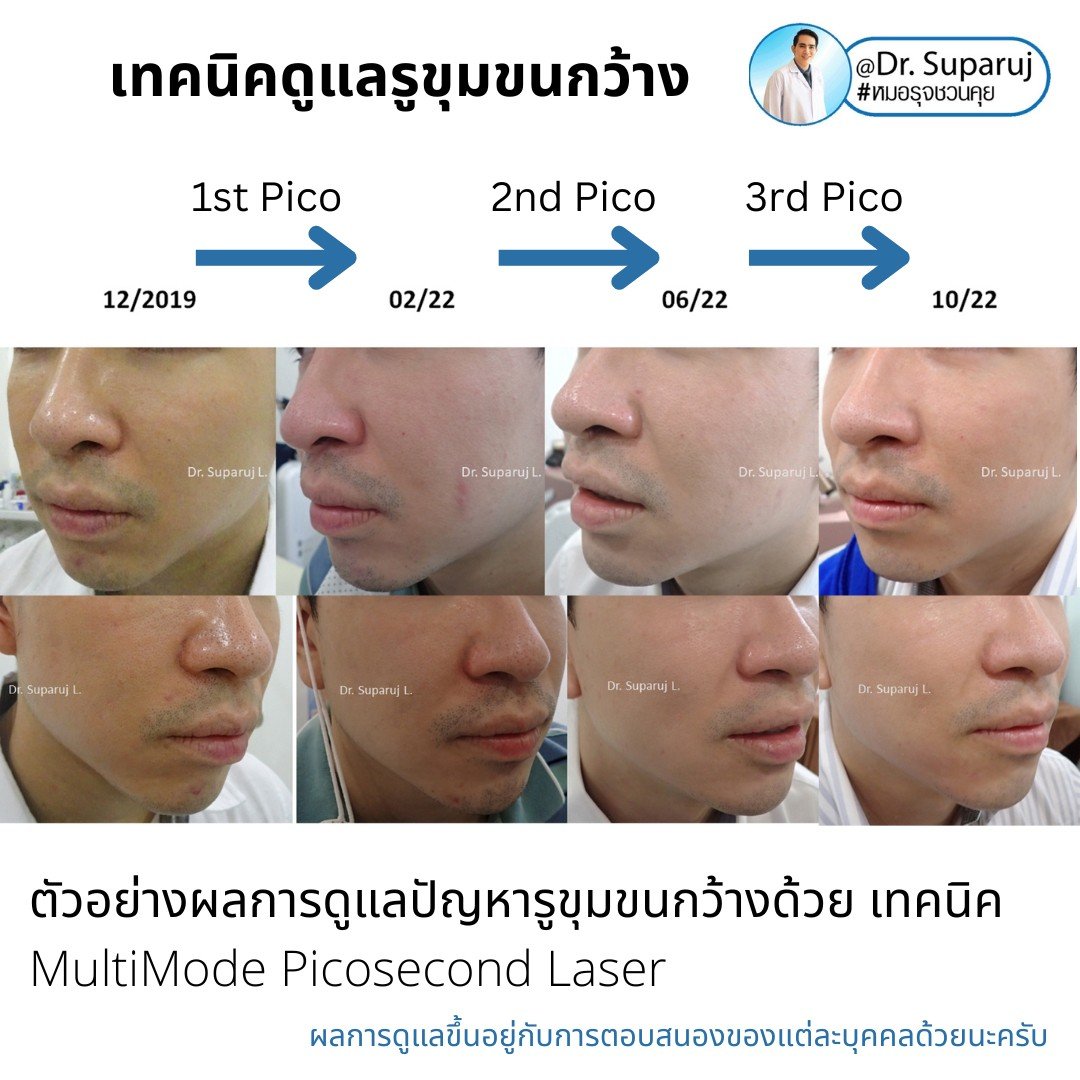 แนะนำเทคนิคดูแลรูขุมขนกว้าง: ตัวอย่างผลการดูแลรูขุมขนกว้าง Enlarged Facial Pore ด้วย MultiMode Picosecond Laser แนะนำเทคนิคดูแลรูขุมขนกว้าง: ตัวอย่างผลการดูแลรูขุมขนกว้าง Enlarged Facial Pore ด้วย MultiMode Picosecond Laser