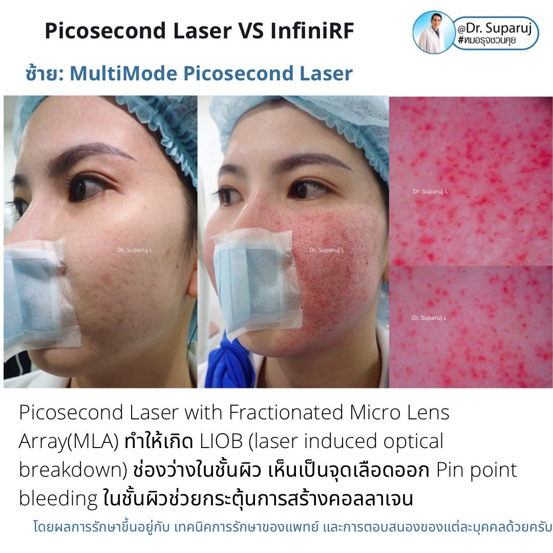 Update ผลการรักษาหลุมสิวด้วย Picosecond Laser VS InfiniRF Microneedle แตกต่างกันอย่างไร อันไหนมีประสิทธิภาพดีกว่า ? Update ผลการรักษาหลุมสิวด้วย Picosecond Laser VS InfiniRF Microneedle แตกต่างกันอย่างไร อันไหนมีประสิทธิภาพดีกว่า ?