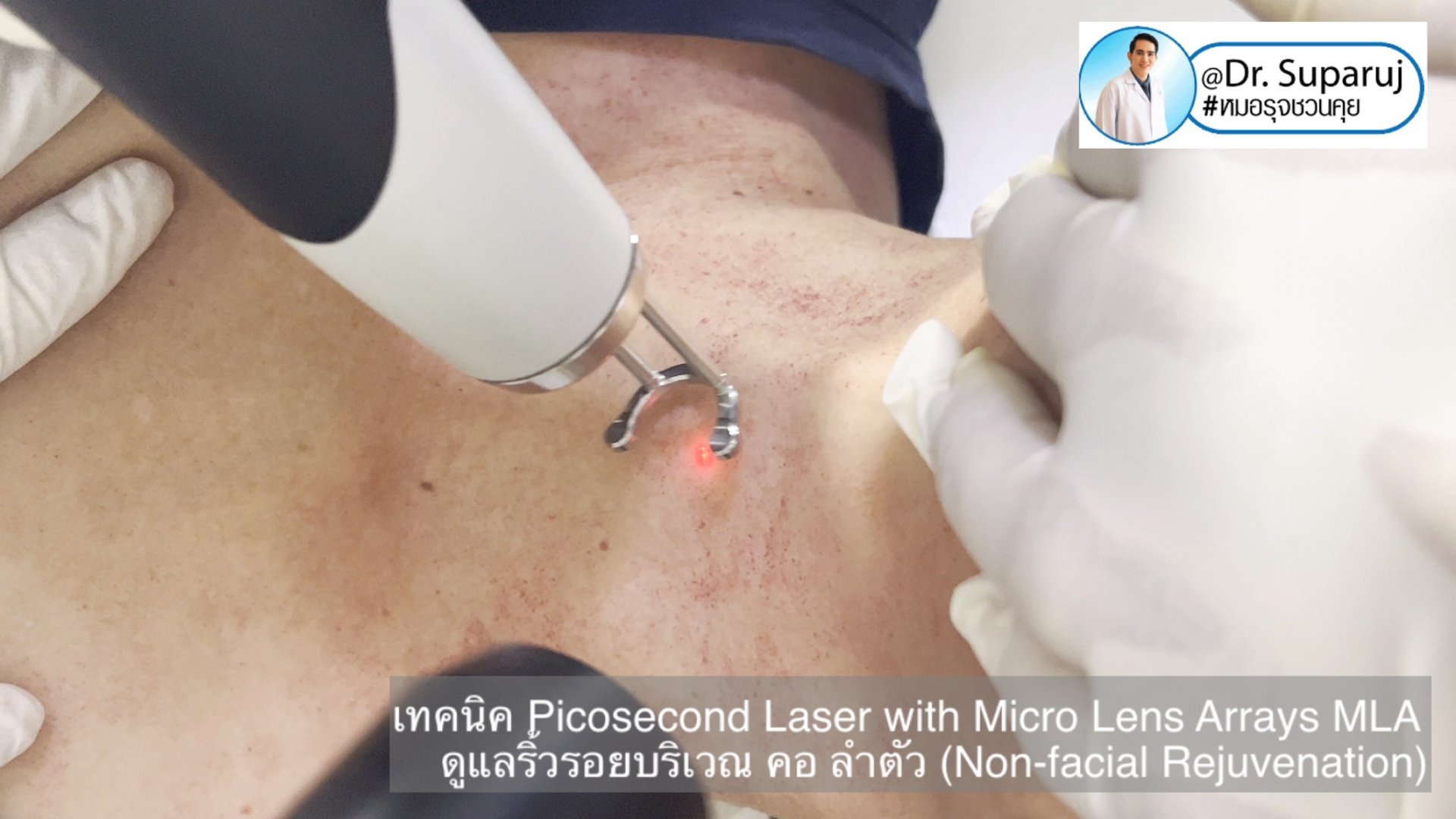 แนะนำ เทคนิคการใช้เลเซอร์ Picosecond Laser with Micro Lens Arrays MLA เพื่อดูแลริ้วรอยบริเวณ คอ ลำตัว (Non-facial rejuvenation) แนะนำ เทคนิคการใช้เลเซอร์ Picosecond Laser with Micro Lens Arrays MLA เพื่อดูแลริ้วรอยบริเวณ คอ ลำตัว (Non-facial rejuvenation)