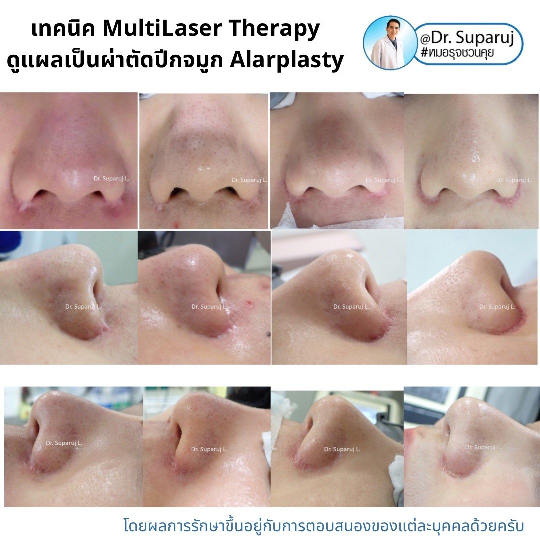 เทคนิคดูแลแผลเป็นด้วยเทคนิค MultiMode MultiLayer Discovery Picosecond Laser with Micro Lens Array MLA