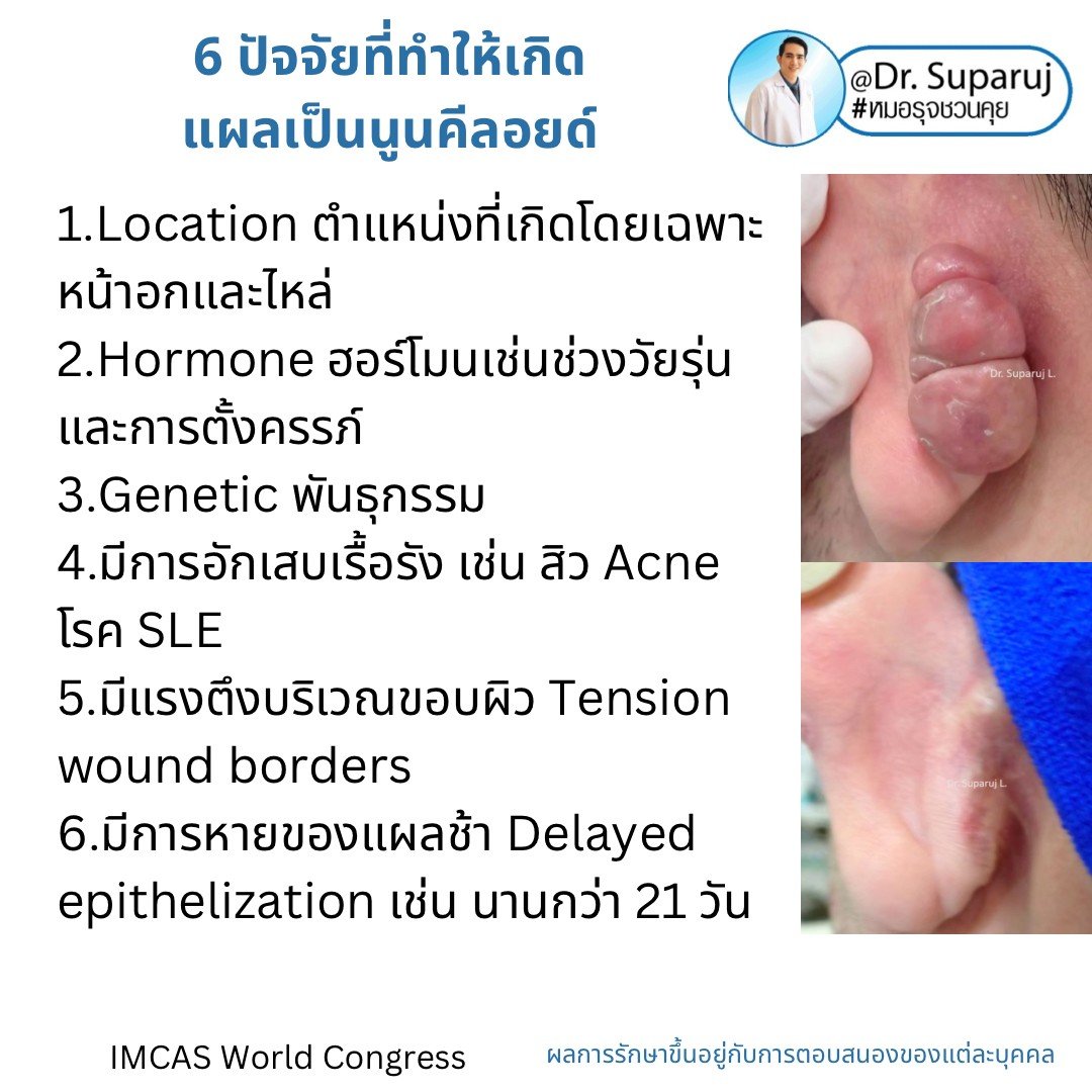 Update เทคนิคดูแลแผลเป็นนูนคีลอยด์ 2022 Update เทคนิคดูแลแผลเป็นนูนคีลอยด์ 2022