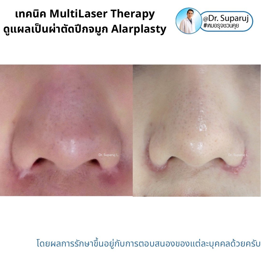 เทคนิคดูแลแผลเป็นด้วยเทคนิค MultiMode MultiLayer Discovery Picosecond Laser with Micro Lens Array MLA