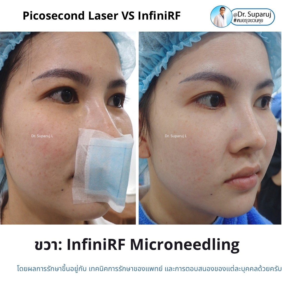 Update ผลการรักษาหลุมสิวด้วย Picosecond Laser VS InfiniRF Microneedle แตกต่างกันอย่างไร อันไหนมีประสิทธิภาพดีกว่า ?