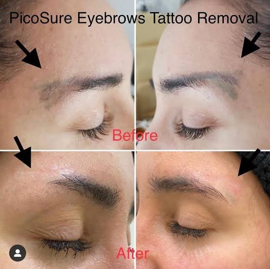 เทคนิคลบรอยสักคิ้ว ด้วยเลเซอร์ Picosecond Laser และลบรอยสักสีเนื้อต้องระวังอะไรบ้าง ? เทคนิคลบรอยสักคิ้ว ด้วยเลเซอร์ Picosecond Laser และลบรอยสักสีเนื้อต้องระวังอะไรบ้าง ?