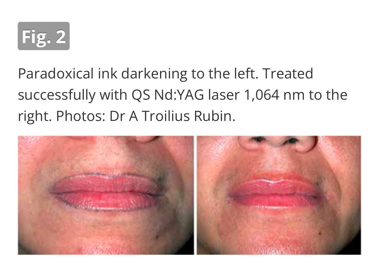 เทคนิคลบรอยสักคิ้ว ด้วยเลเซอร์ Picosecond Laser และลบรอยสักสีเนื้อต้องระวังอะไรบ้าง ? เทคนิคลบรอยสักคิ้ว ด้วยเลเซอร์ Picosecond Laser และลบรอยสักสีเนื้อต้องระวังอะไรบ้าง ?