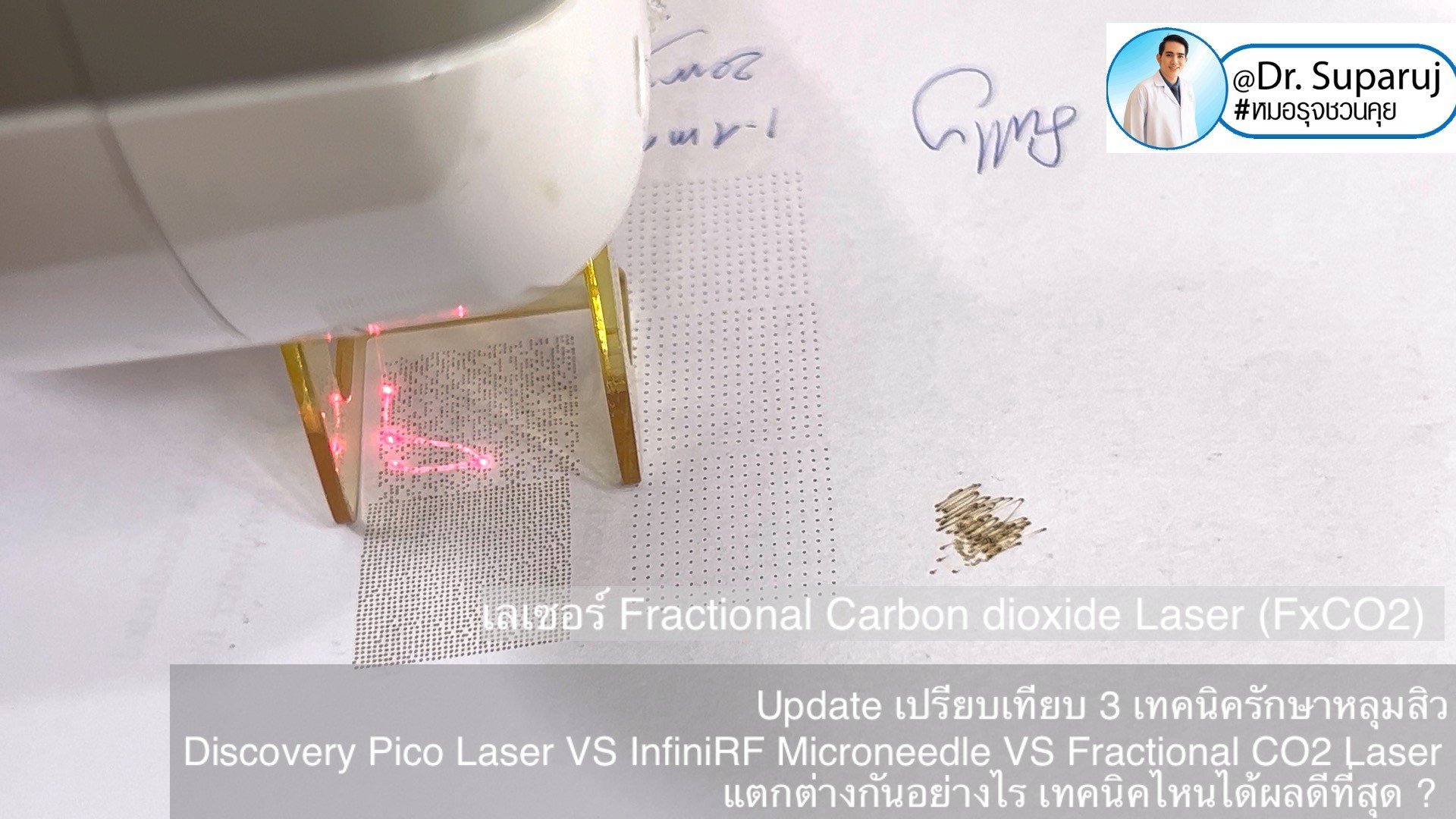 ผลการรักษาหลุมสิวด้วย Picosecond Laser VS InfiniRF Microneedle แตกต่างกันอย่างไร อะไรมีประสิทธิภาพดีกว่า ?
