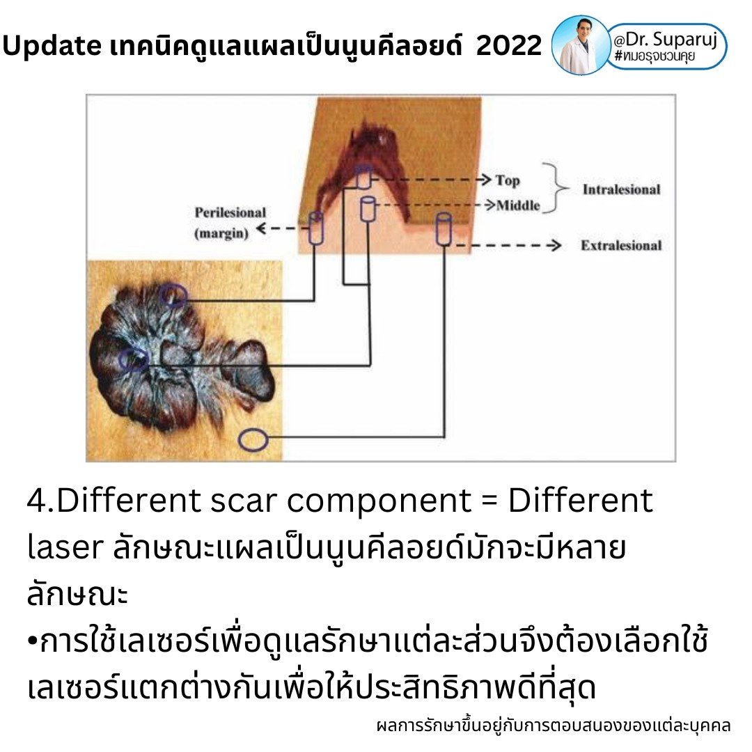 Update เทคนิคดูแลแผลเป็นนูนคีลอยด์ 2022 Update เทคนิคดูแลแผลเป็นนูนคีลอยด์ 2022