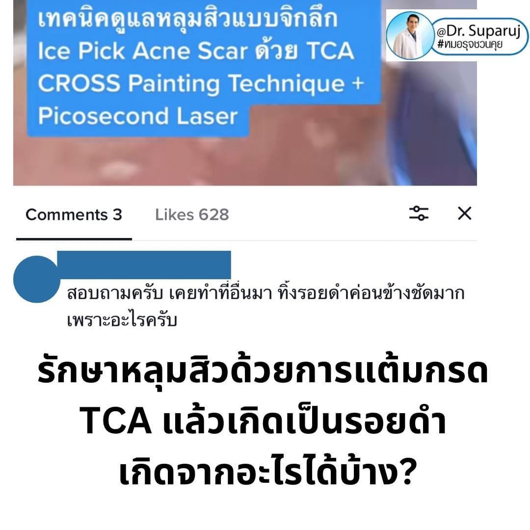 รักษาหลุมสิวด้วยการแต้มกรด TCA แล้วเกิดเป็นรอยดำ เกิดจากอะไรได้บ้าง?