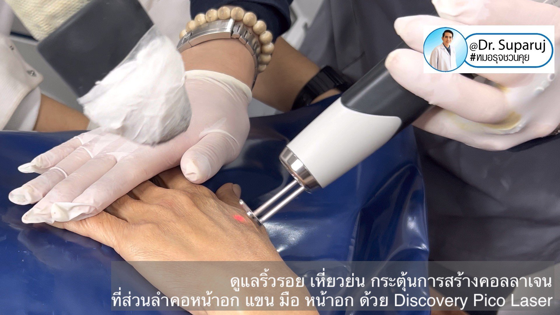 เทคนิคดูแลริ้วรอย เหี่ยวย่น กระตุ้นการสร้างคอลลาเจน ที่ส่วนลำคอหน้าอก แขน มือ หน้าอก ด้วย Discovery Pico Laser เทคนิคดูแลริ้วรอย เหี่ยวย่น กระตุ้นการสร้างคอลลาเจน ที่ส่วนลำคอหน้าอก แขน มือ หน้าอก ด้วย Discovery Pico Laser