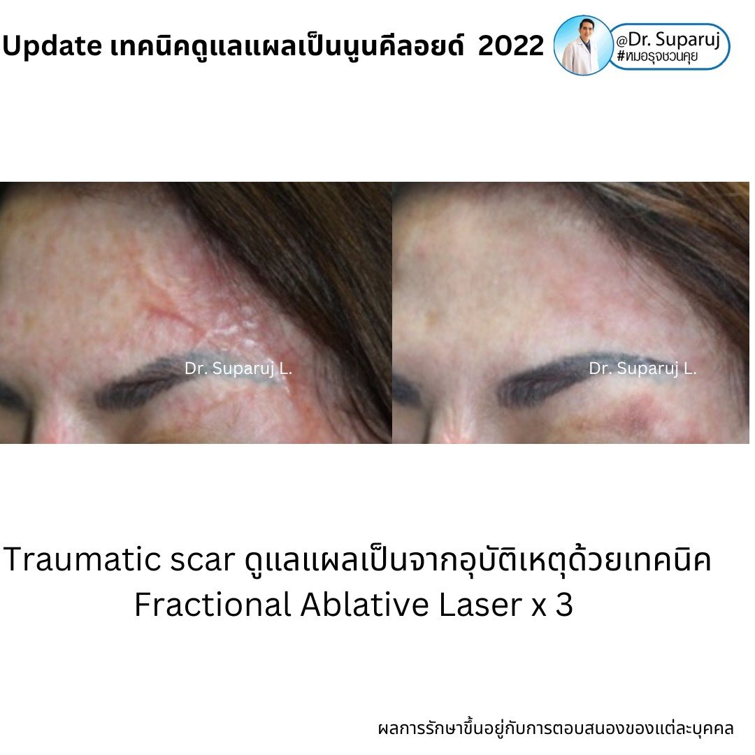 แผลเป็นนูนคีลอยคีลอยด์สามารถรักษาด้วยโดยวิธีผ่าตัดออกได้ไหม ? แผลเป็นนูนคีลอยคีลอยด์สามารถรักษาด้วยโดยวิธีผ่าตัดออกได้ไหม ?