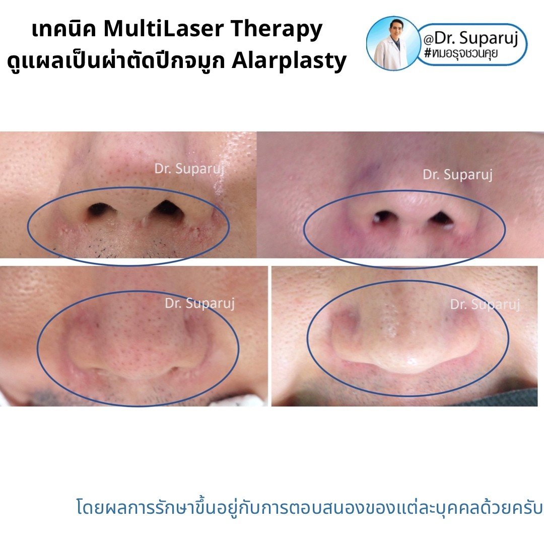 แนะนำเทคนิคดูแลแผลเป็นจากการผ่าตัด: ดูแลแผลเป็นนูนจากการผ่าตัดปีกจมูก Alarplasty ด้วยเทคนิค MultiLaser Therapy: Picosecond Laser + Gold Toning + Fractional Laser + Injection