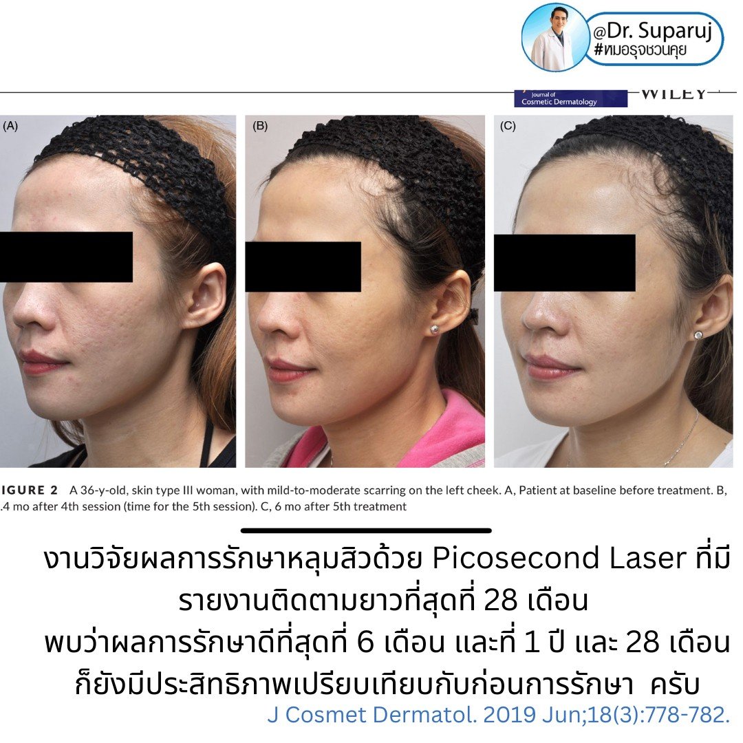 Q: หลังรักษาหลุมสิวด้วยเลเซอร์หรือเทคนิคต่างๆ หลังจากรักษาเรียบร้อยแล้ว จะมีโอกาสกลับมายุบตัว หรือหลุมสิวจะกลับมาแบบเดิมไหม? Q: หลังรักษาหลุมสิวด้วยเลเซอร์หรือเทคนิคต่างๆ หลังจากรักษาเรียบร้อยแล้ว จะมีโอกาสกลับมายุบตัว หรือหลุมสิวจะกลับมาแบบเดิมไหม?