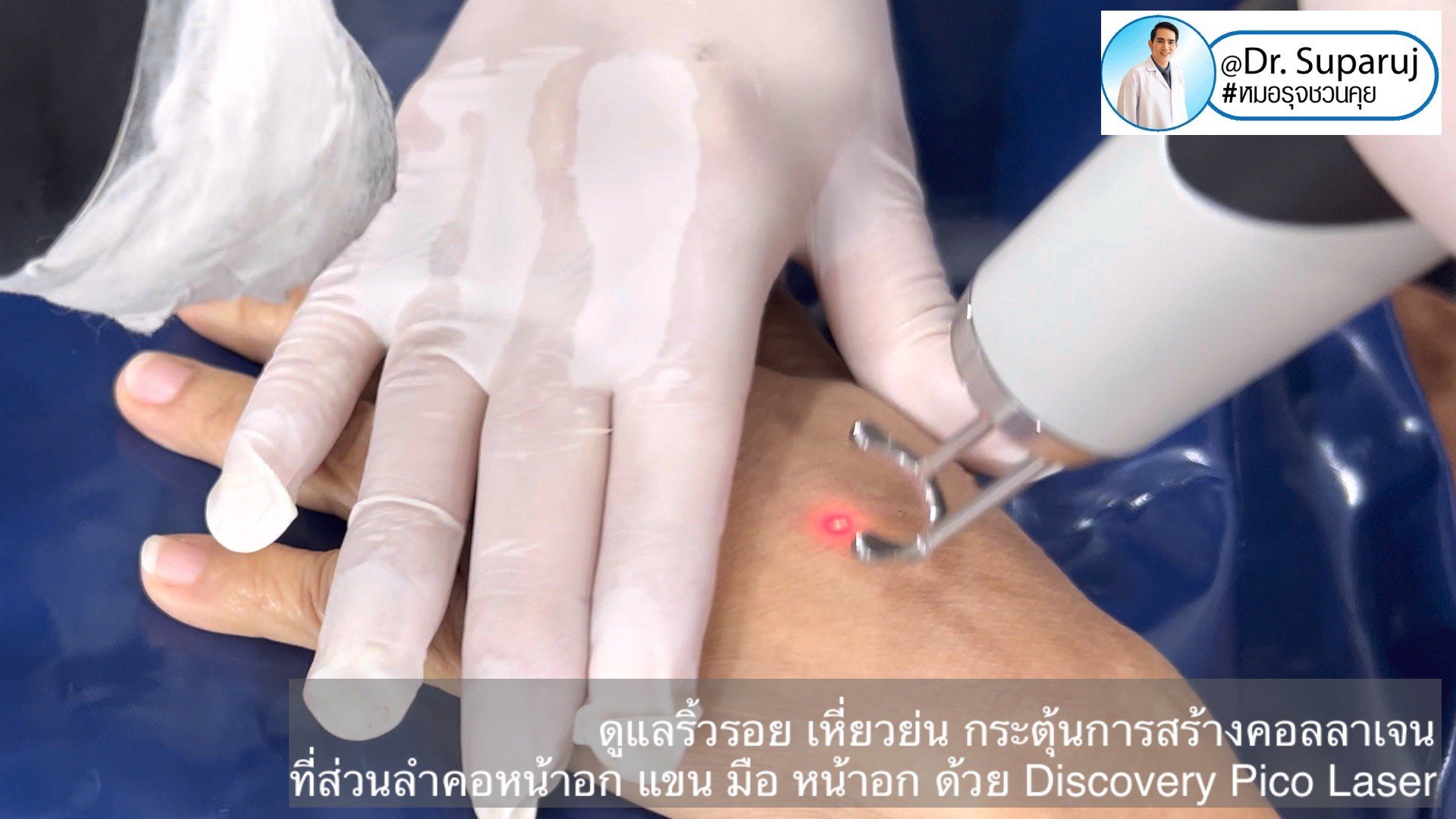 เทคนิคดูแลริ้วรอย เหี่ยวย่น กระตุ้นการสร้างคอลลาเจน ที่ส่วนลำคอหน้าอก แขน มือ หน้าอก ด้วย Discovery Pico Laser เทคนิคดูแลริ้วรอย เหี่ยวย่น กระตุ้นการสร้างคอลลาเจน ที่ส่วนลำคอหน้าอก แขน มือ หน้าอก ด้วย Discovery Pico Laser