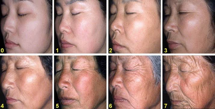 •สกินแคร์อาจจะเริ่มมีบทบาทน้อยลงโดยจะช่วย ให้ผิวไม่เกิดริ้วรอยเพิ่มขึ้นได้ในระดับนึง แต่อาจจะไม่สามารถช่วยลดริ้วรอยที่เกิดขึ้นแล้วได้ครับ (do not reverese aging) โดยอาจใช้ Retinol, Niacinamide, Ascorbic Acid •สกินแคร์อาจจะเริ่มมีบทบาทน้อยลงโดยจะช่วย ให้ผิวไม่เกิดริ้วรอยเพิ่มขึ้นได้ในระดับนึง แต่อาจจะไม่สามารถช่วยลดริ้วรอยที่เกิดขึ้นแล้วได้ครับ (do not reverese aging) โดยอาจใช้ Retinol, Niacinamide, Ascorbic Acid