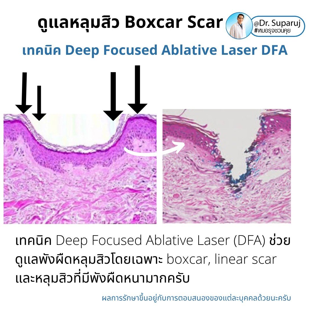แนะนำเทคนิคดูแลหลุมสิว: เทคนิค Deep Focused Ablative Laser (DFA) ดูแลหลุมสิวลึกขอบชัดพังผืดหนา Boxcar Scar และหลุมสิวลักษณะเส้นยาว Linear scar
