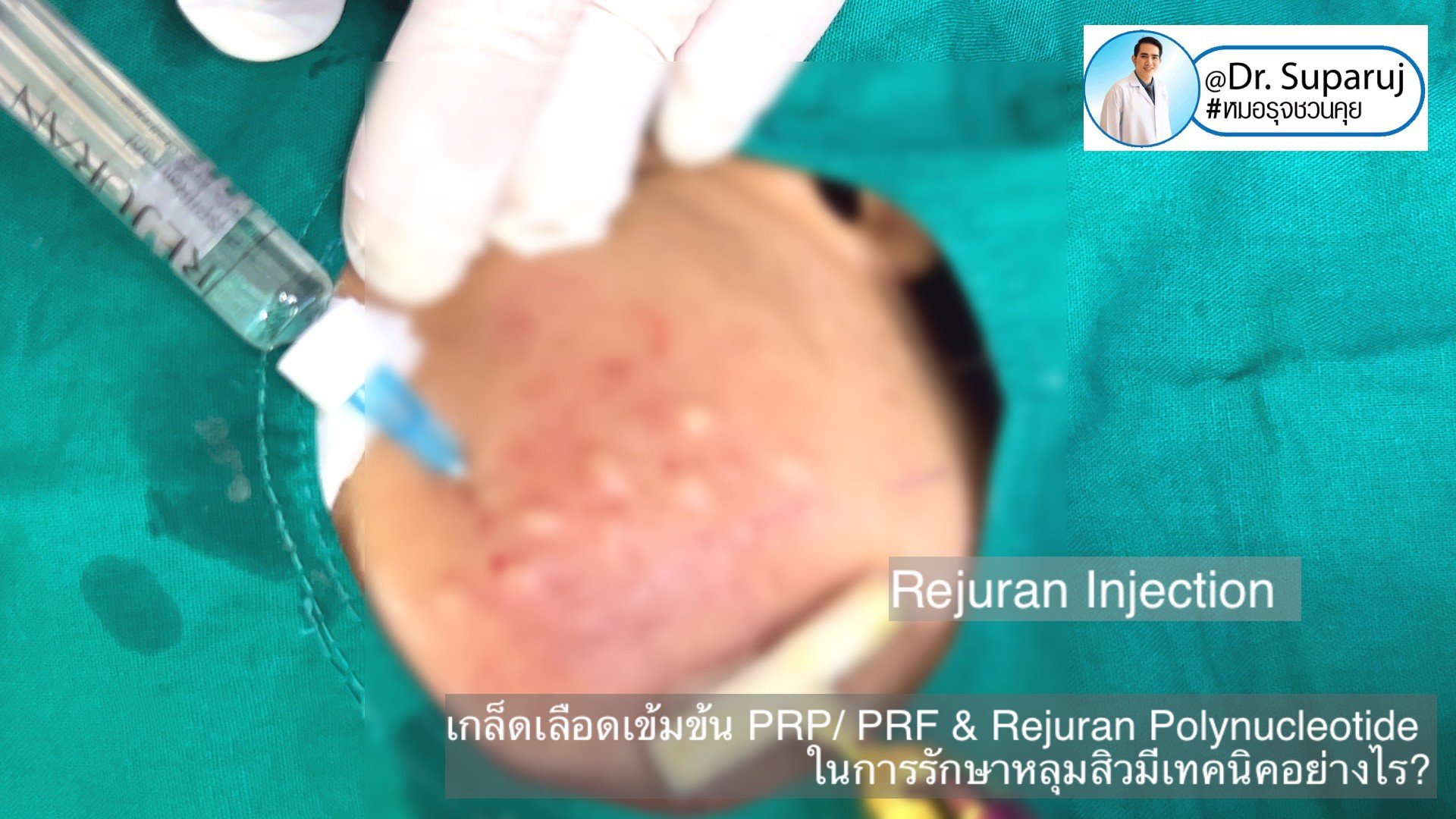 Update เทคนิคดูแลหลุมสิวด้วย Rejuran และ เกล็ดเลือดเข้มข้น PRP/PRF มีเทคนิคอย่างไร? เทคนิคไหนได้ผลดีกว่า ? Update เทคนิคดูแลหลุมสิวด้วย Rejuran และ เกล็ดเลือดเข้มข้น PRP/PRF มีเทคนิคอย่างไร? เทคนิคไหนได้ผลดีกว่า ?