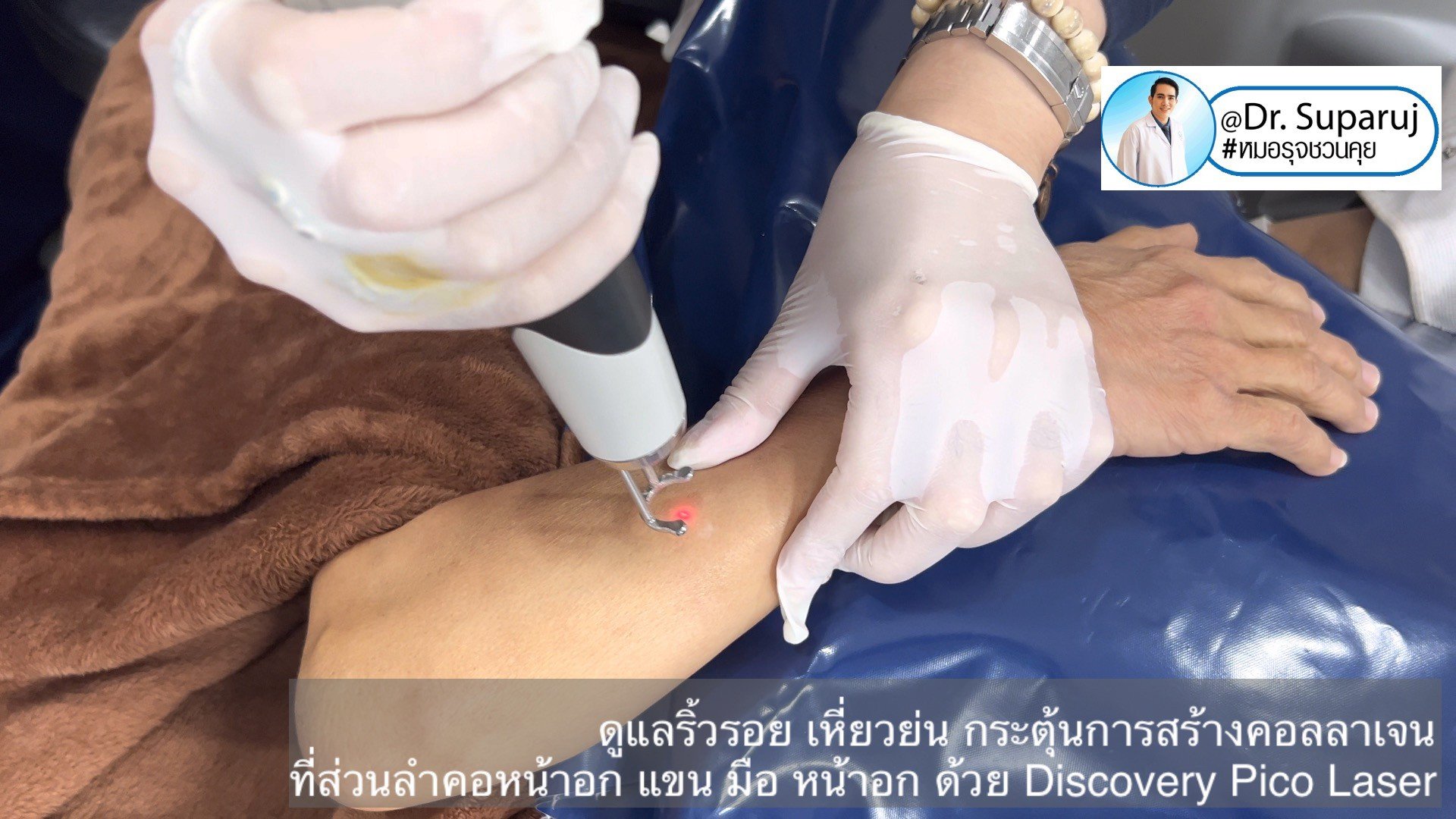 เทคนิคดูแลริ้วรอย เหี่ยวย่น กระตุ้นการสร้างคอลลาเจน ที่ส่วนลำคอหน้าอก แขน มือ หน้าอก ด้วย Discovery Pico Laser เทคนิคดูแลริ้วรอย เหี่ยวย่น กระตุ้นการสร้างคอลลาเจน ที่ส่วนลำคอหน้าอก แขน มือ หน้าอก ด้วย Discovery Pico Laser