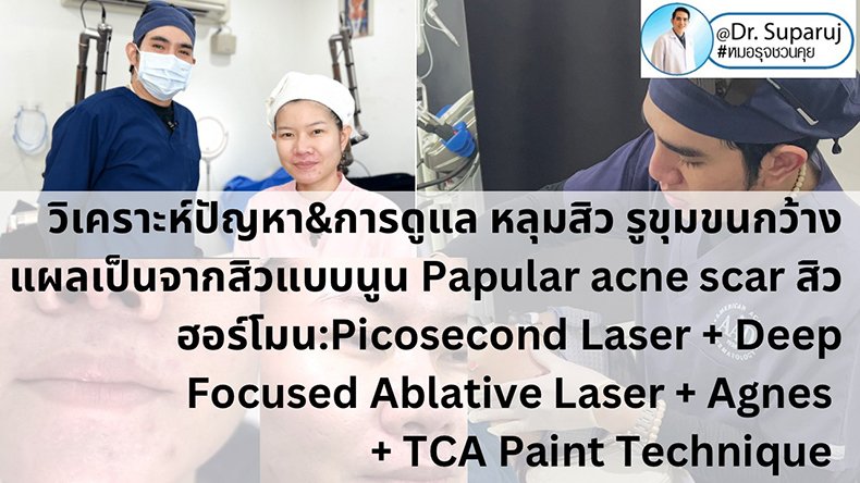 เทคนิควิเคราะห์ปัญหา & รักษาหลุมสิว รูขุมขนกว้าง แผลเป็นจากสิวแบบนูน Papular acne scar สิวฮอร์โมน: ด้วย Picosecond Laser + Deep Focused Ablative Laser + Agnes + TCA Paint Technique
