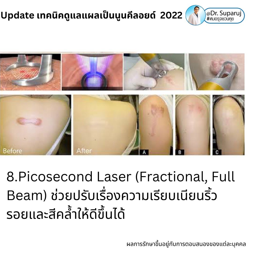 Update เทคนิคดูแลแผลเป็นนูนคีลอยด์ 2022 Update เทคนิคดูแลแผลเป็นนูนคีลอยด์ 2022