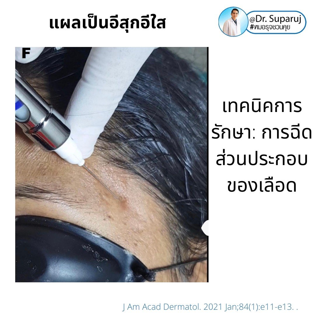 แผลเป็นยุบตัวจากอีสุกอีใส Chicken pox scars ดูแลได้อย่างไร ? แผลเป็นยุบตัวจากอีสุกอีใส Chicken pox scars ดูแลได้อย่างไร ?