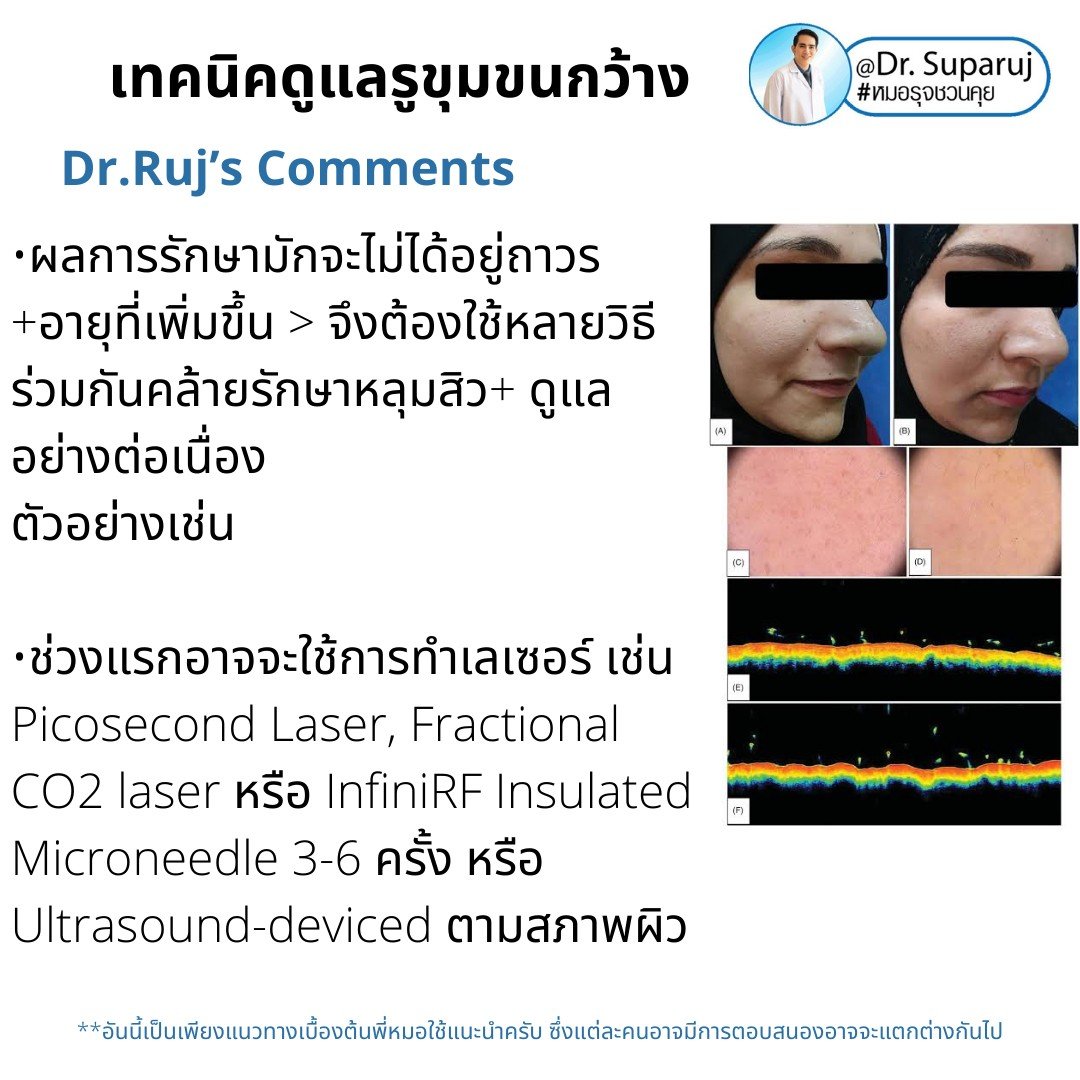 เทคนิควิเคราะห์ & รักษาขุมขนกว้าง Enlarged Facial Pore ด้วยกล้อส่องขยายพิเศษทางผิวหนัง Dermoscopy เทคนิควิเคราะห์ & รักษาขุมขนกว้าง Enlarged Facial Pore ด้วยกล้อส่องขยายพิเศษทางผิวหนัง Dermoscopy