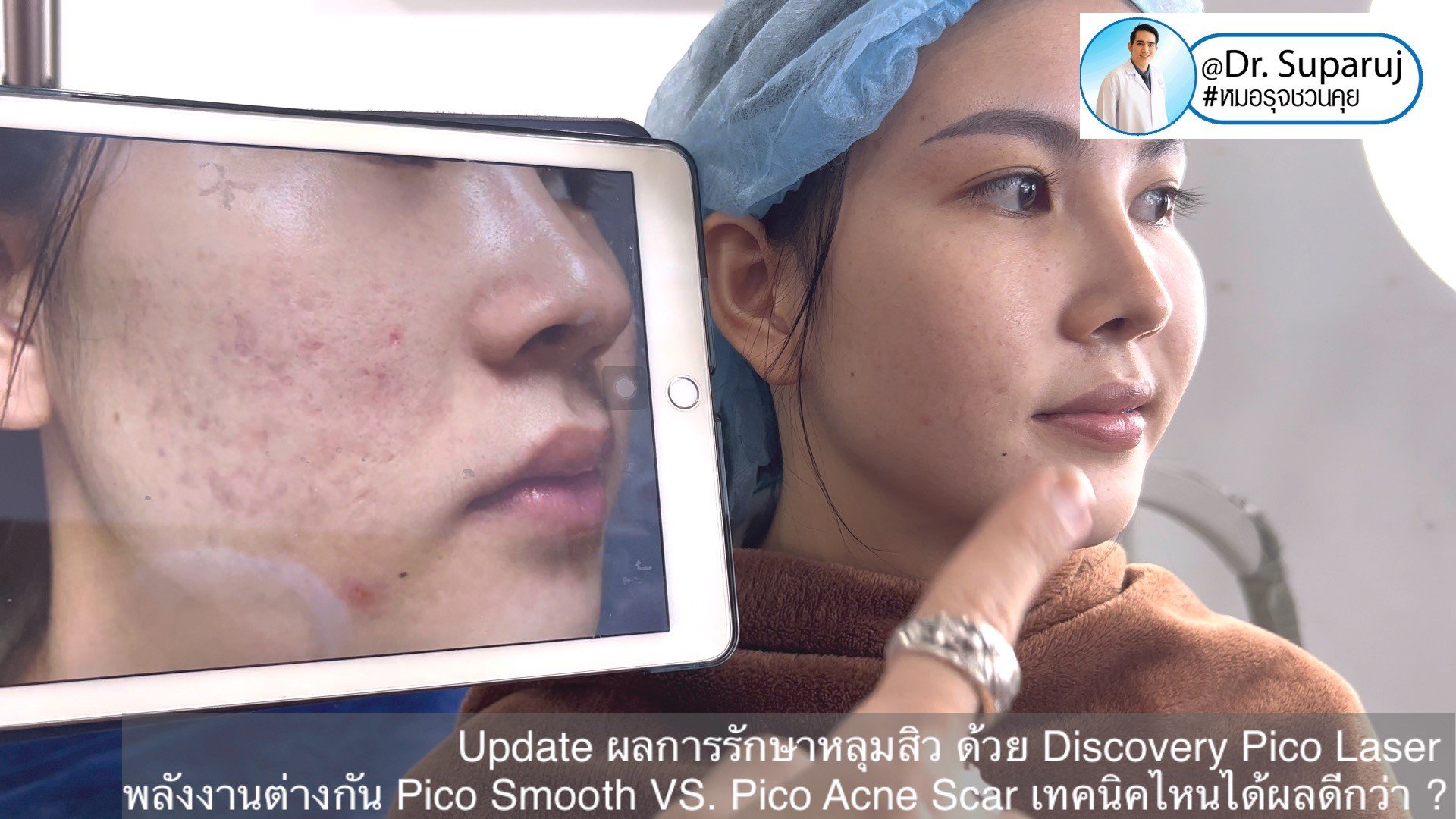  Update ผลการรักษาหลุมสิว ด้วย Discovery Pico Laser พลังงานต่างกัน Pico Smooth (Moderate Fluence) VS. Pico Acne Scar (High Fluence)เทคนิคไหนได้ผลดีกว่า ?